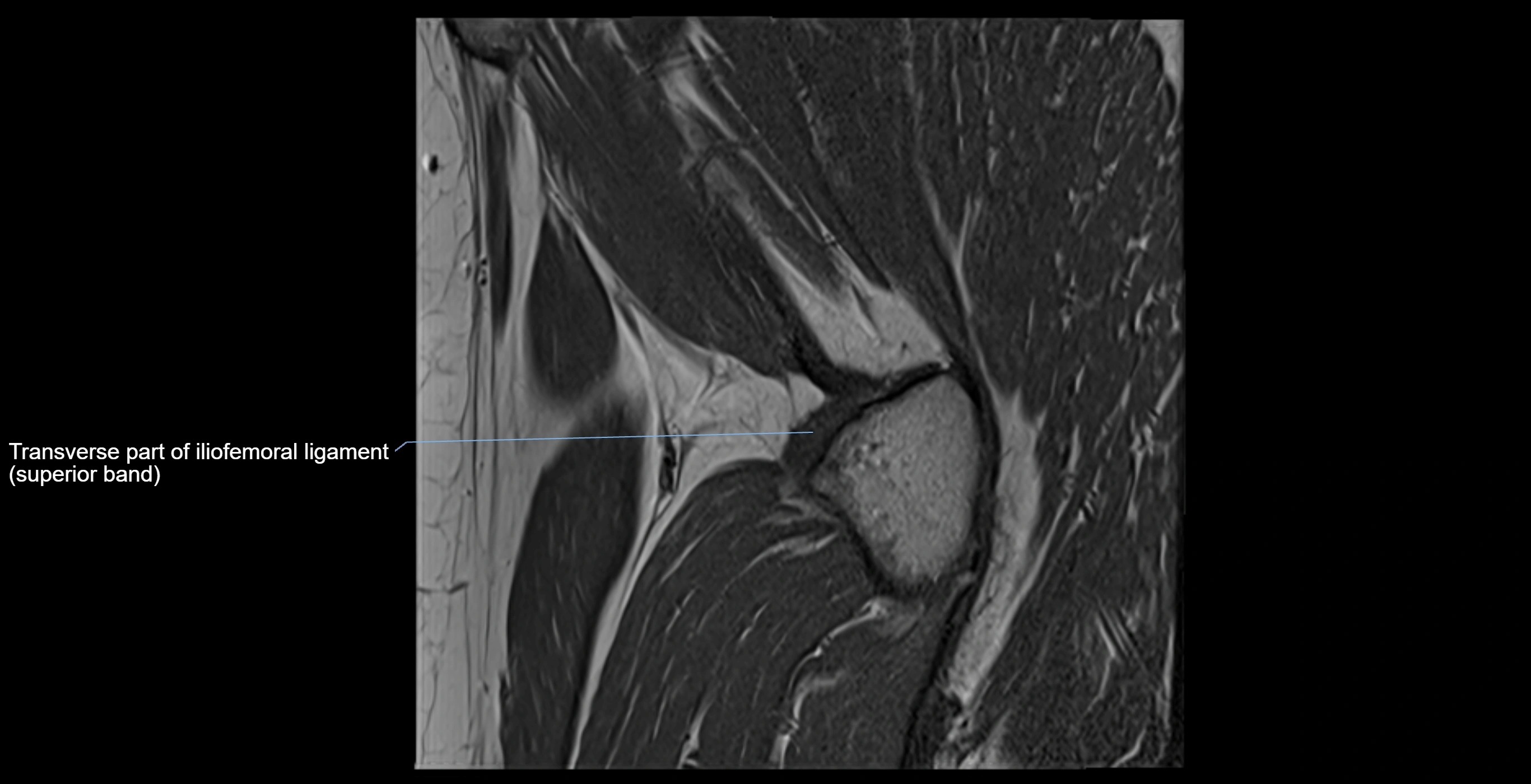 MRI Hip ligaments sagittal cross sectional anatomy 3T  radiology  image-img-00001-00023.webp